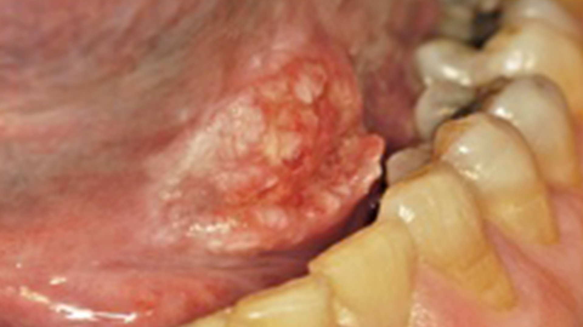 Oral Cancer and Cancer Therapy