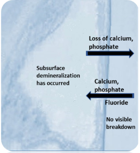 Figure 1. Early phase of the caries process